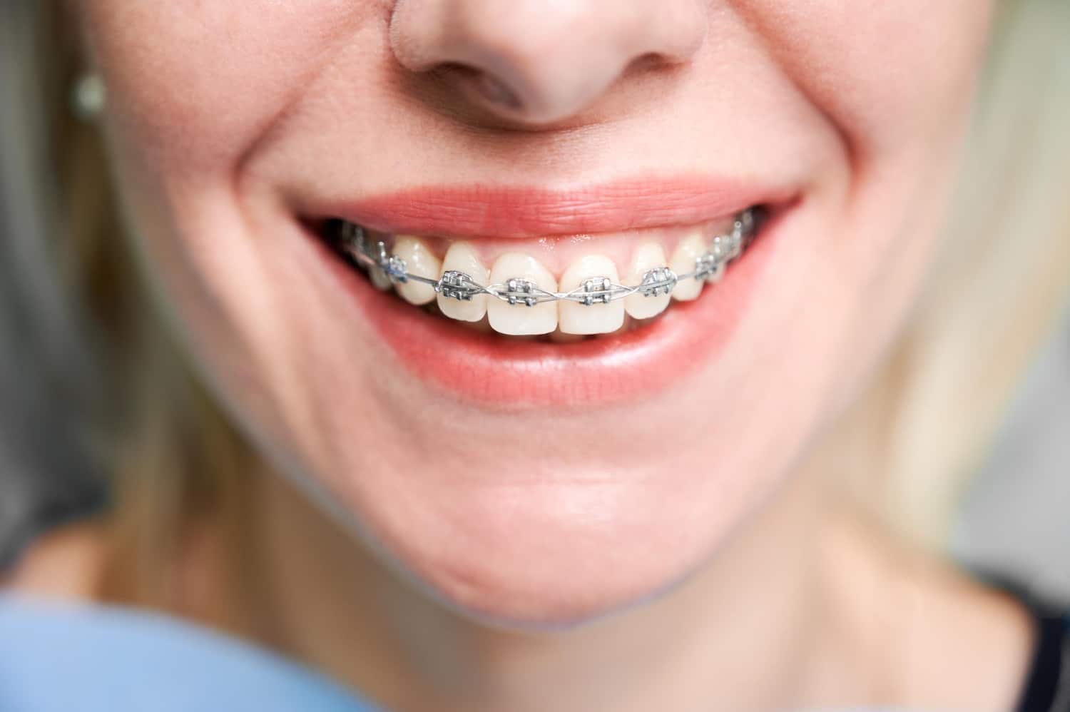 Cost of Braces