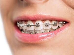 Braces for Adults