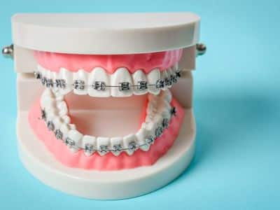 Lingual Braces Vs Traditional Braces