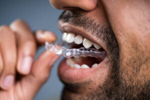 Invisalign Guide: Complete Overview of Aligner Treatment 