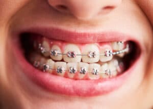 Guide to Dental Braces: Comprehensive Treatment Options