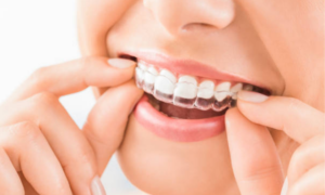 Invisalign Costs Explained